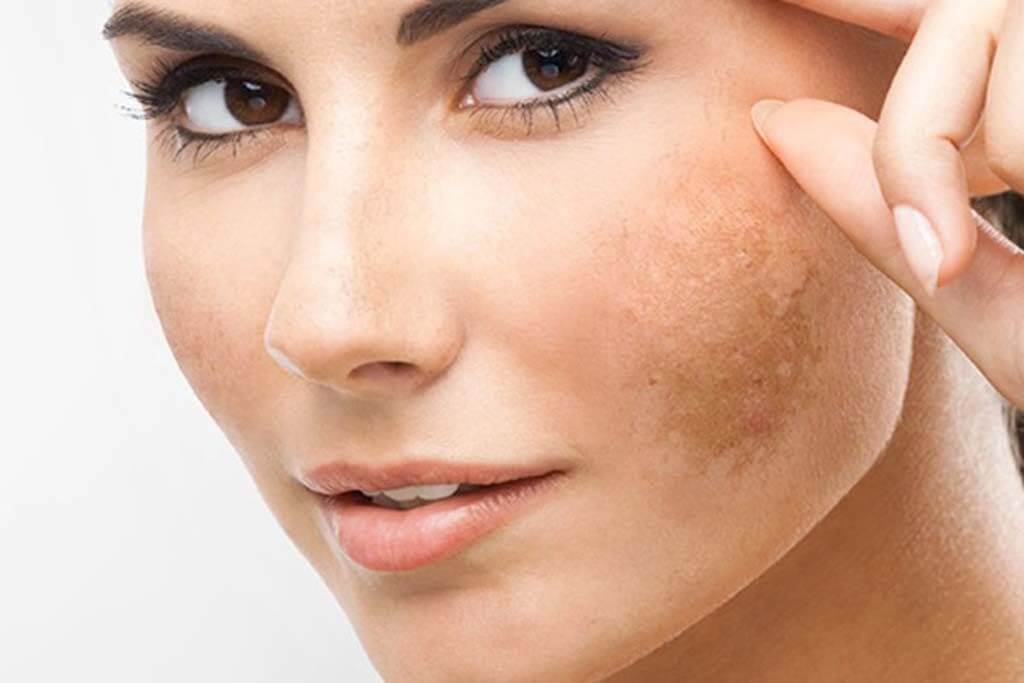 Trị nám với phương pháp xông hơi 